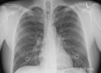 spirometria