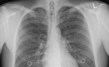 spirometria